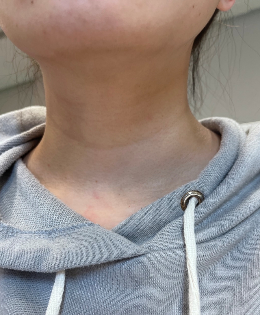 StriVectin團購美國皺效奇蹟繃繃頸霜，使用一個月後脖紋明顯變淡變淺