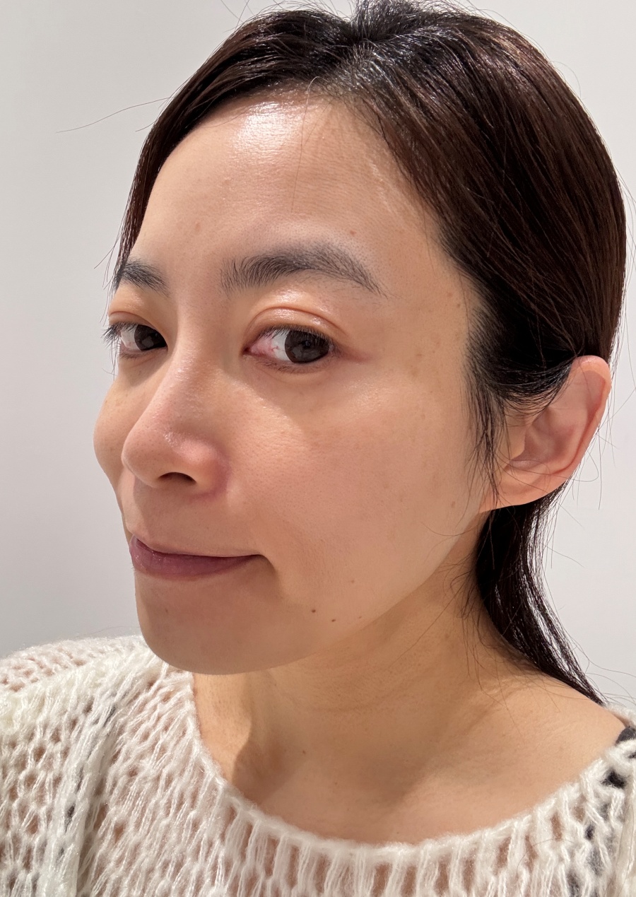 【醫美】怕痛人的索夫波真實心得-琢美妍時尚診所 索夫波施打完沒有傷口可以馬上回去上班