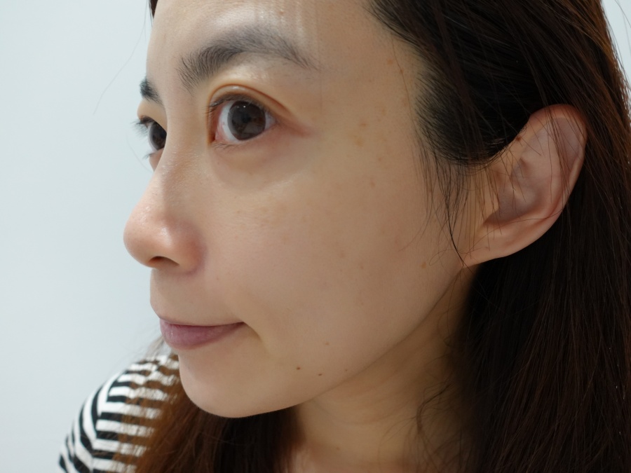 【醫美】怕痛人的索夫波真實心得-琢美妍時尚診所 索夫波施打完三週
