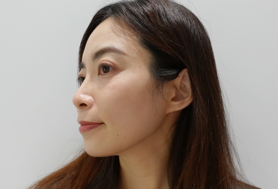 【醫美】怕痛人的索夫波真實心得-琢美妍時尚診所 索夫波施打完第三週